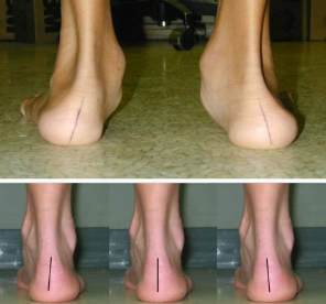 Orthotics Image 1
