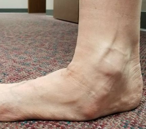 Orthotics Image 2
