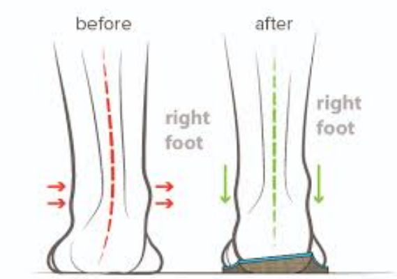 Wear and Tear of Orthotics