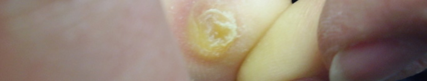 Corns and Callous close-up