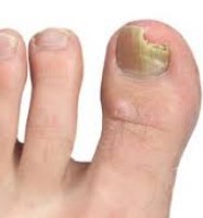 Close-up of a fungal toenail