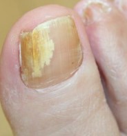 Close-up of another fungal toenail