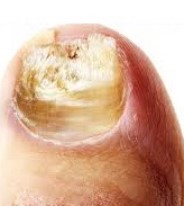 Close-up of a fungal toenail with more severe infection