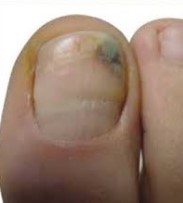 Close-up of a fungal toenail with green discoloration