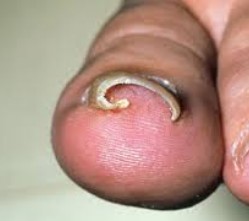 Ingrown Nail Close-up