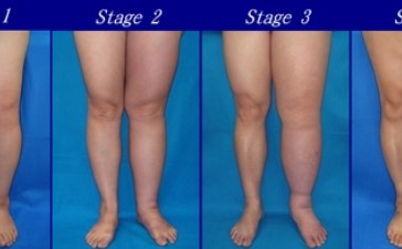 Lymphedema Stages