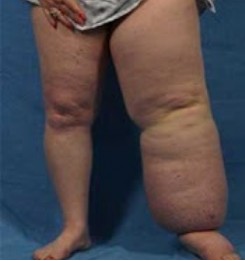Lymphedema Types