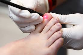 Laser Treatment for Nail Fungus