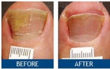 Before and After Treatment 1