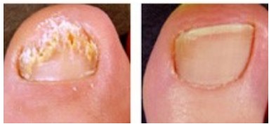 Before and After Treatment 2