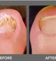 Before and After Laser Treatment