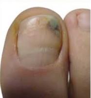 Nail Discoloration