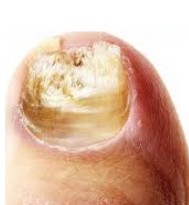 Laser Treatment in Progress