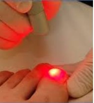 Fungal Nail Progression