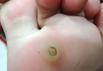Foot Wart