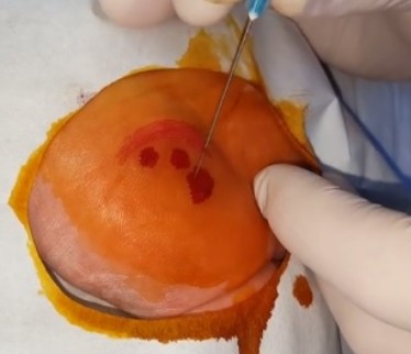 Dry-needling Procedure